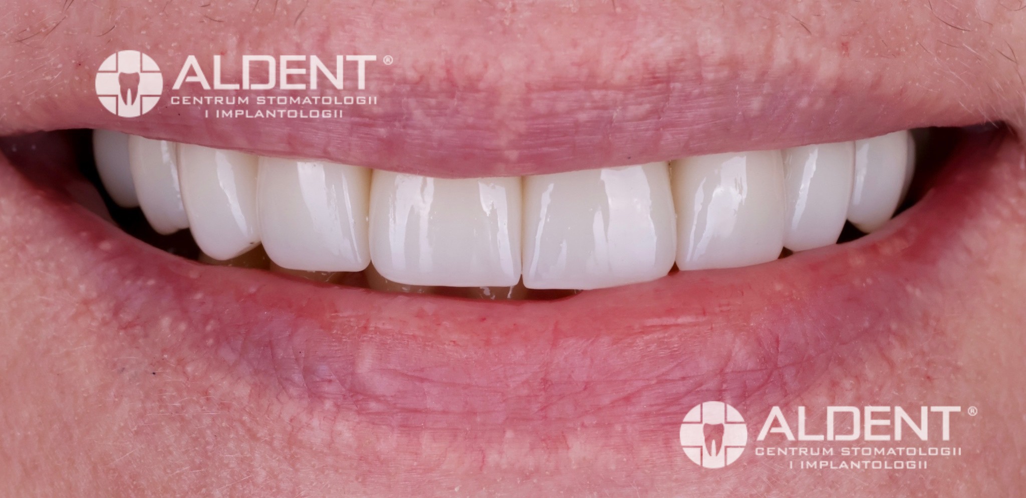 metamorfozy korony cyrkonowe