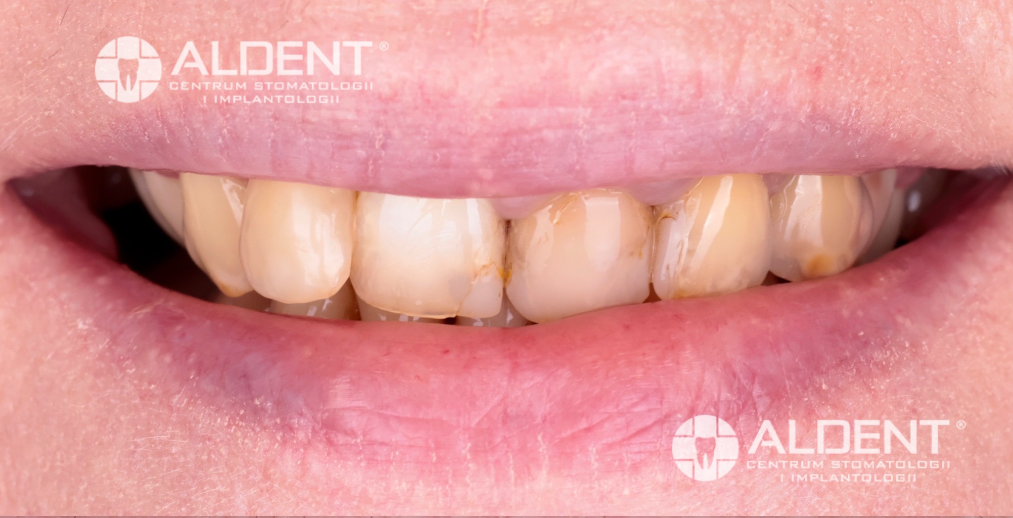 metamorfoza przed koronami cyrkonowymi