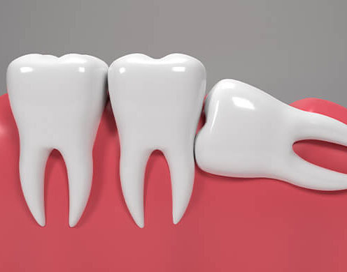 usuwanie ósemek w lublinie chirurgia stomatologiczna aldent