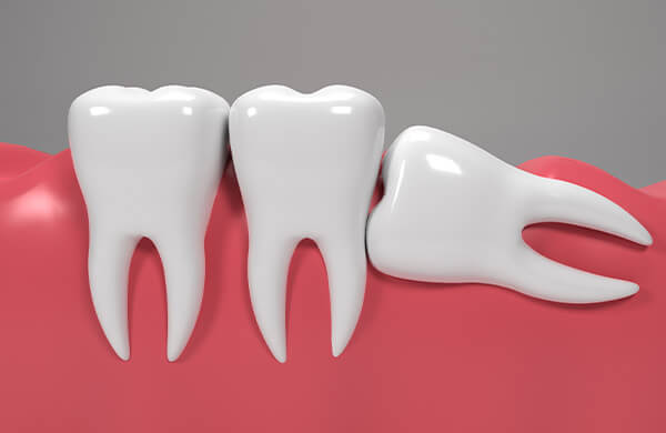 usuwanie ósemek w lublinie chirurgia stomatologiczna aldent