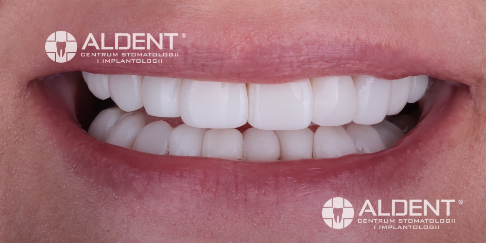 Metamofroza po bondingu