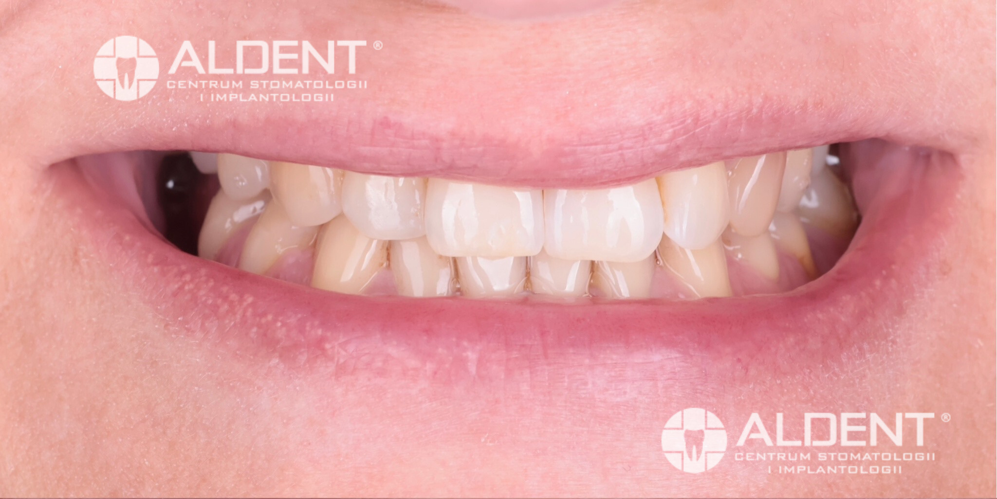 Metamorfoza przed bondingiem