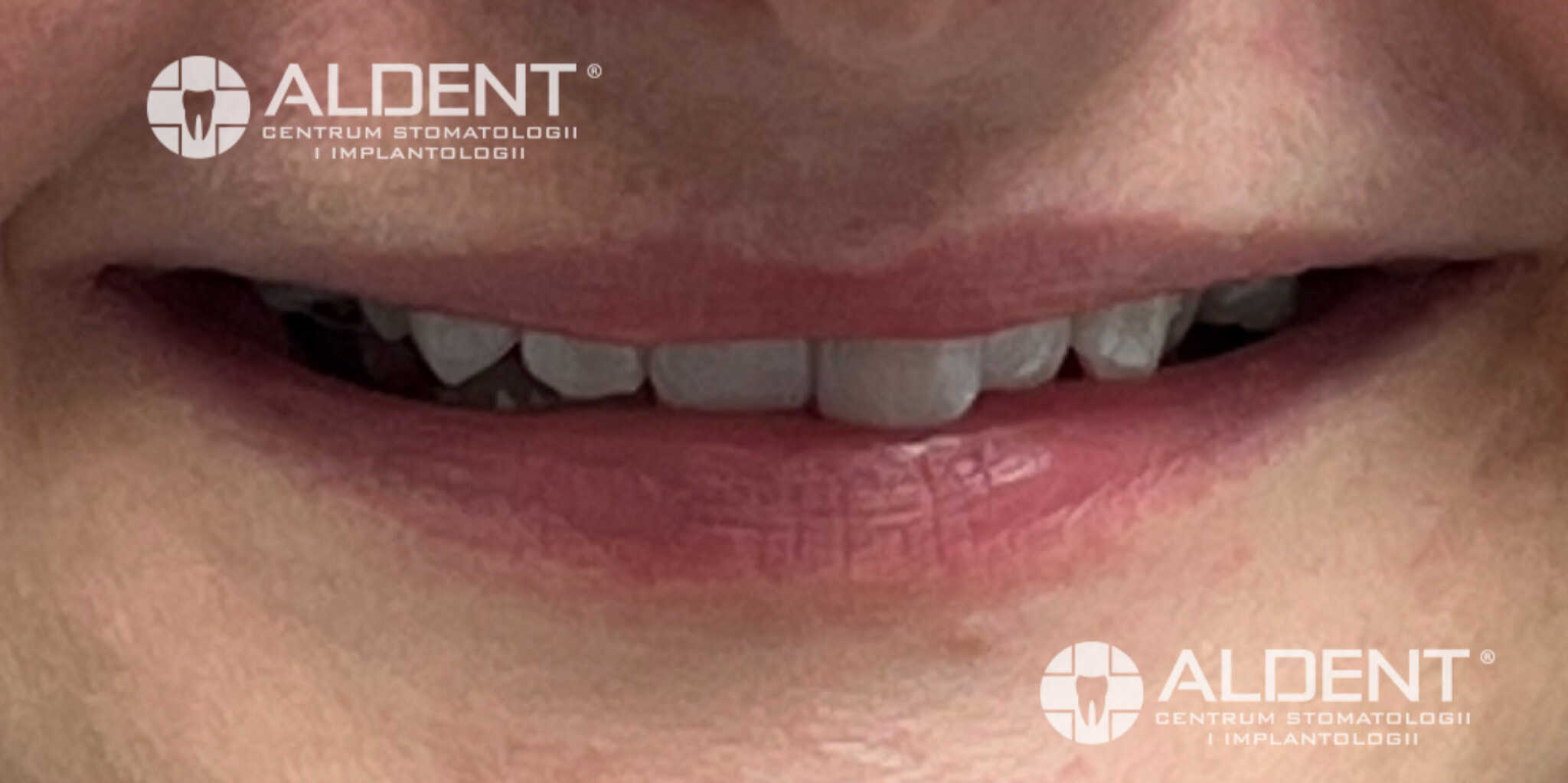 Zęby przed bondingiem