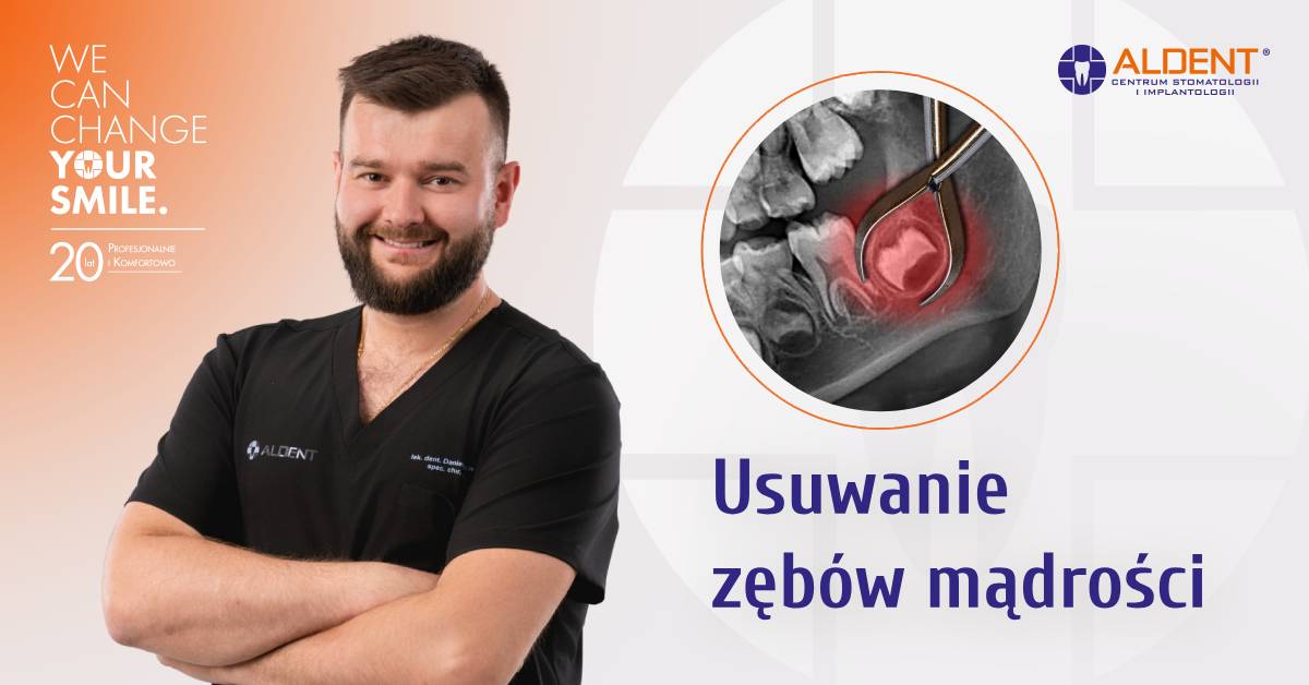 usuwanie zębów mądrości