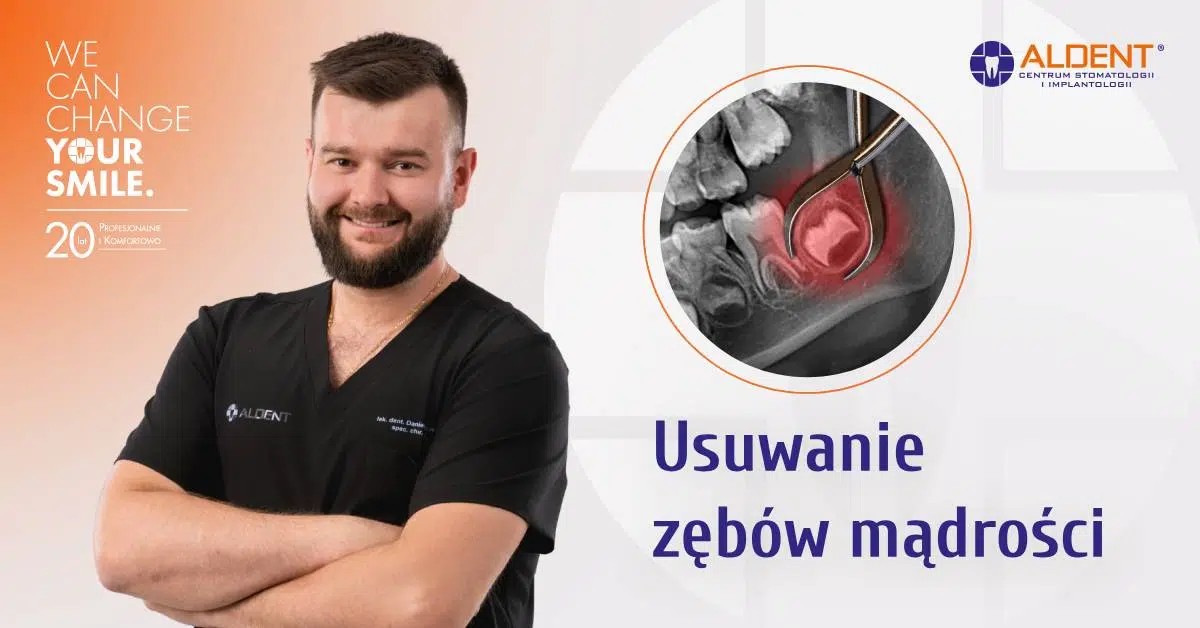 usuwanie zębów mądrości