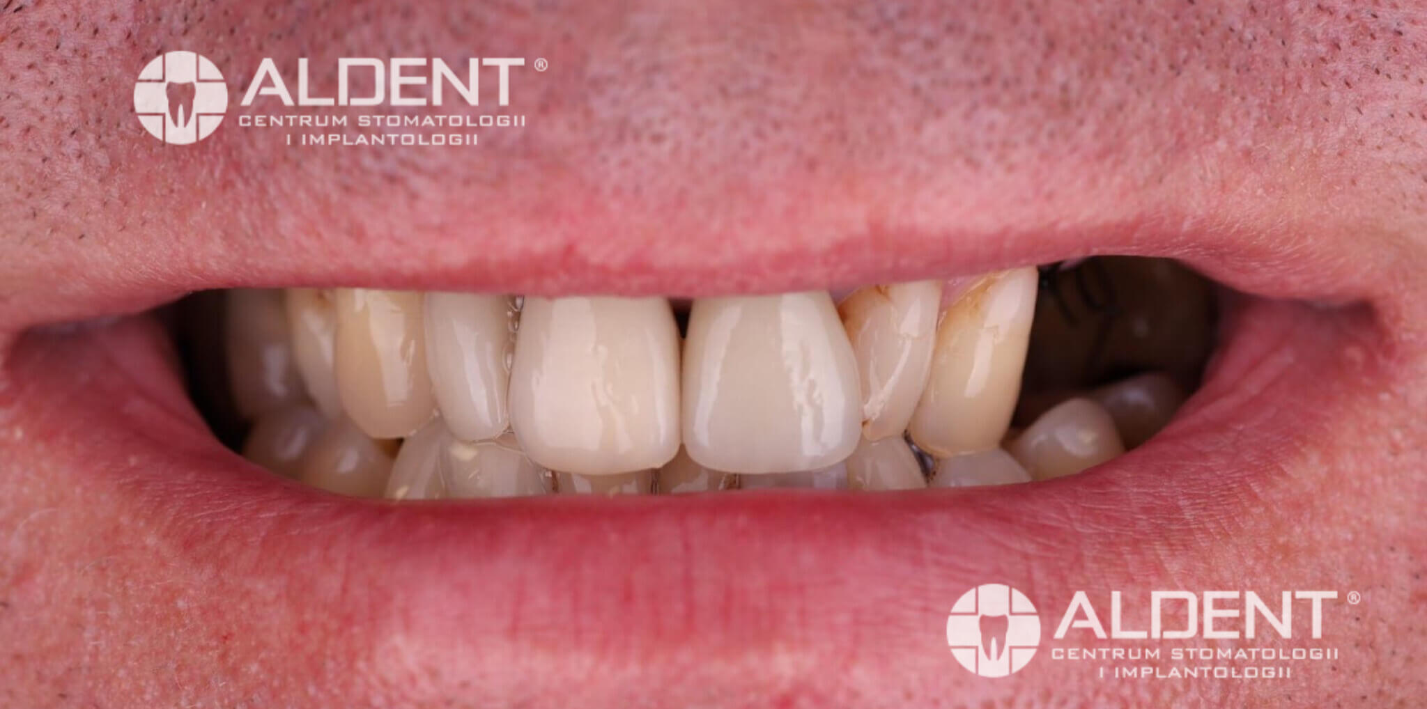 Cyfrowa rekonstrukcja uśmiechu Lublin – stan przed leczeniem