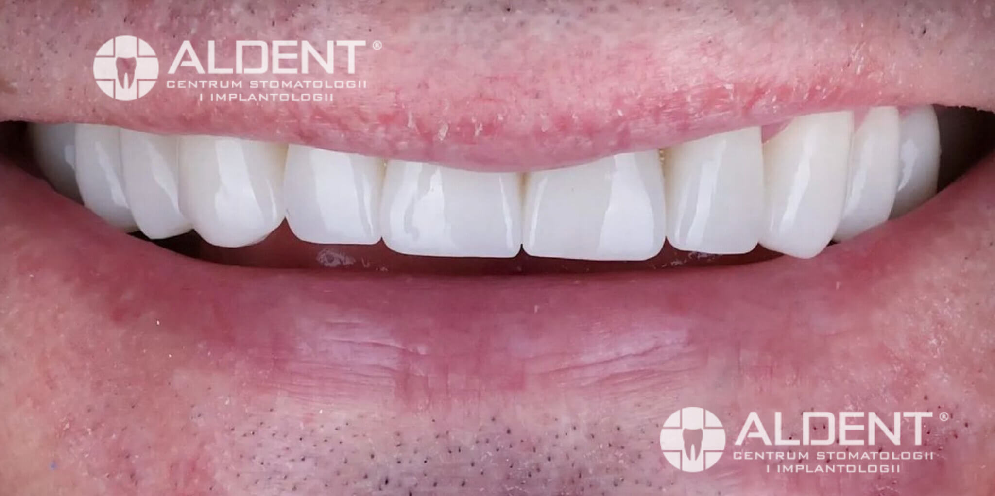 Efekt końcowy leczenia