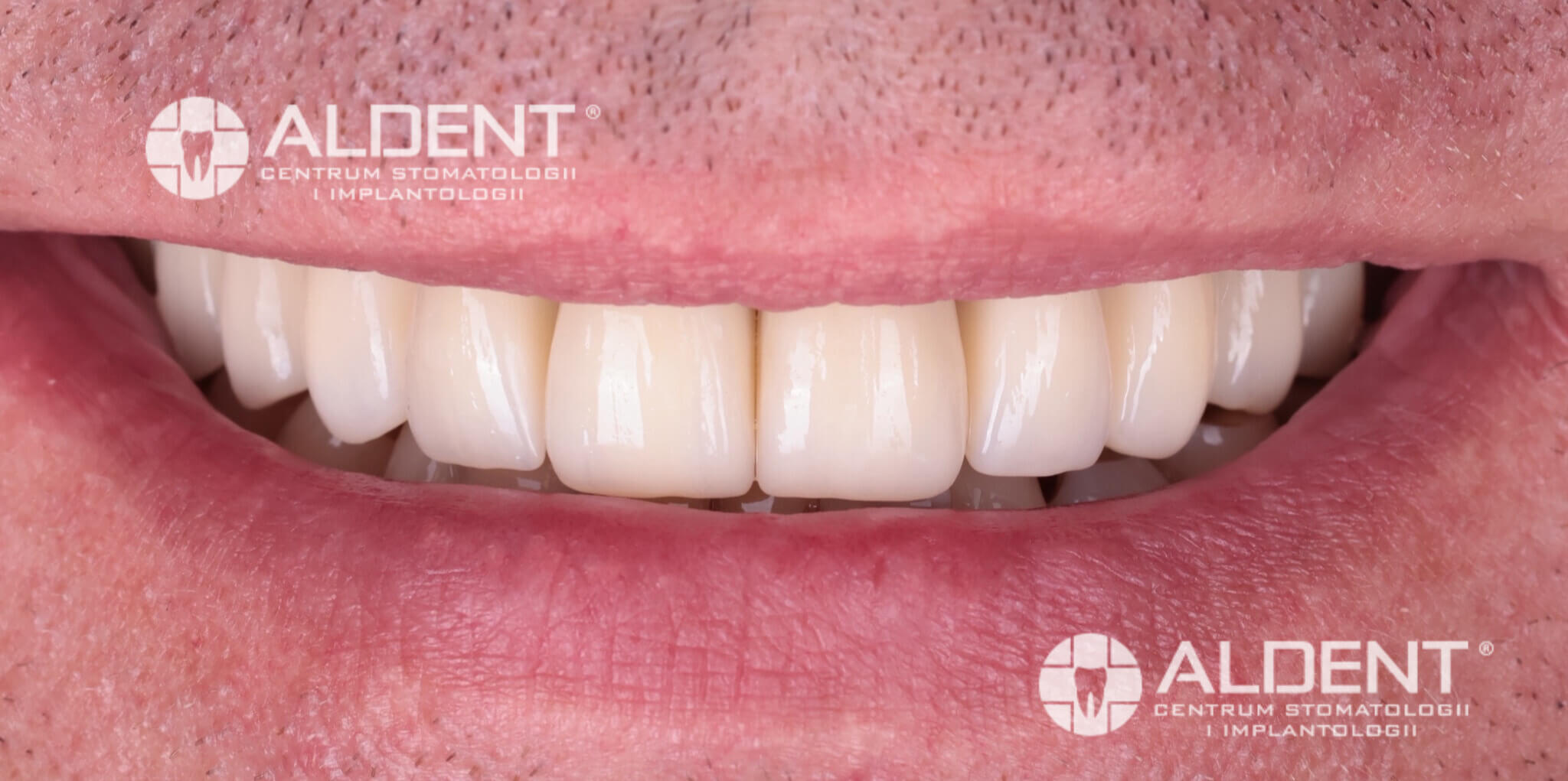 Cyfrowa rekonstrukcja uśmiechu Lublin – stan po leczeniu