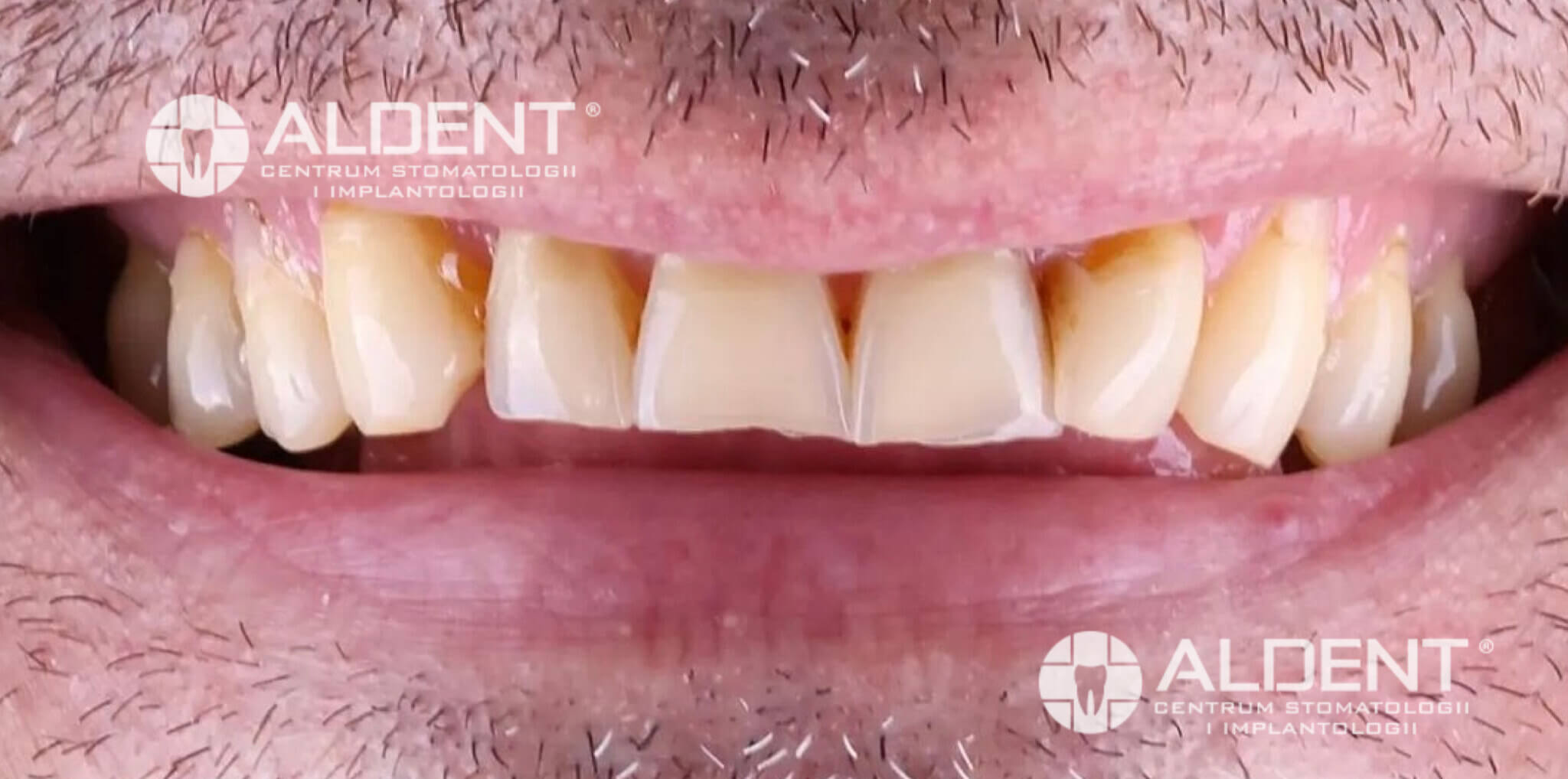 Uśmiech przed leczeniem