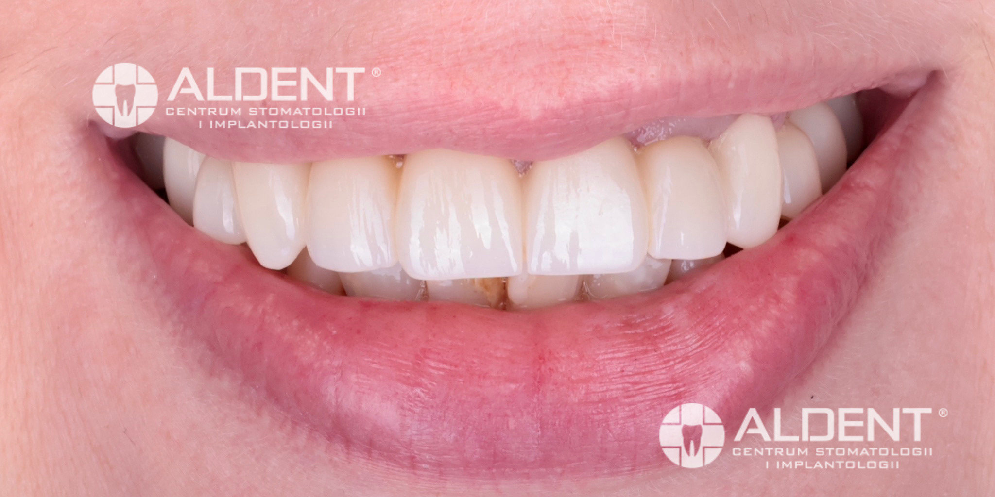 Korony i mosty cyrkonowe Lublin - spektakularny efekt po metamorfozie