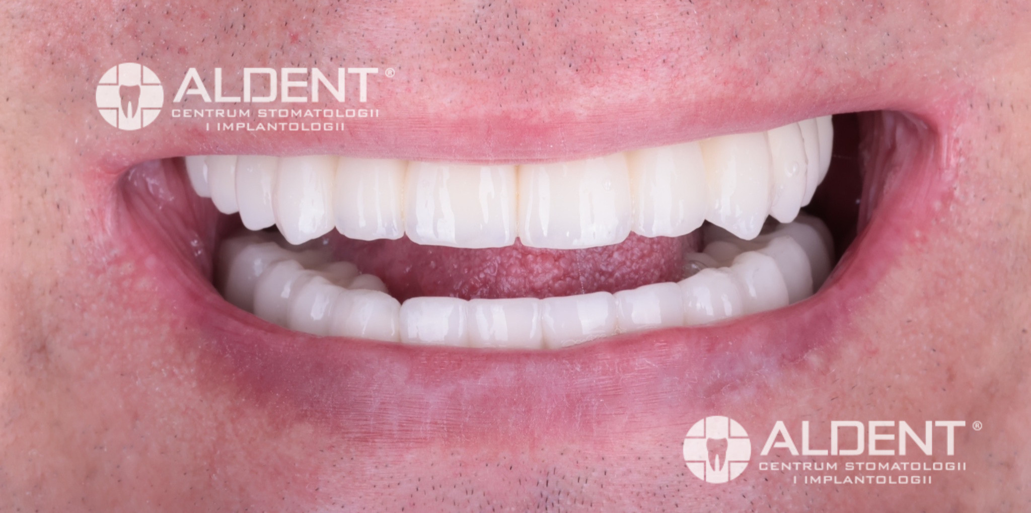 All on 4 w łuku górnym i dolnym