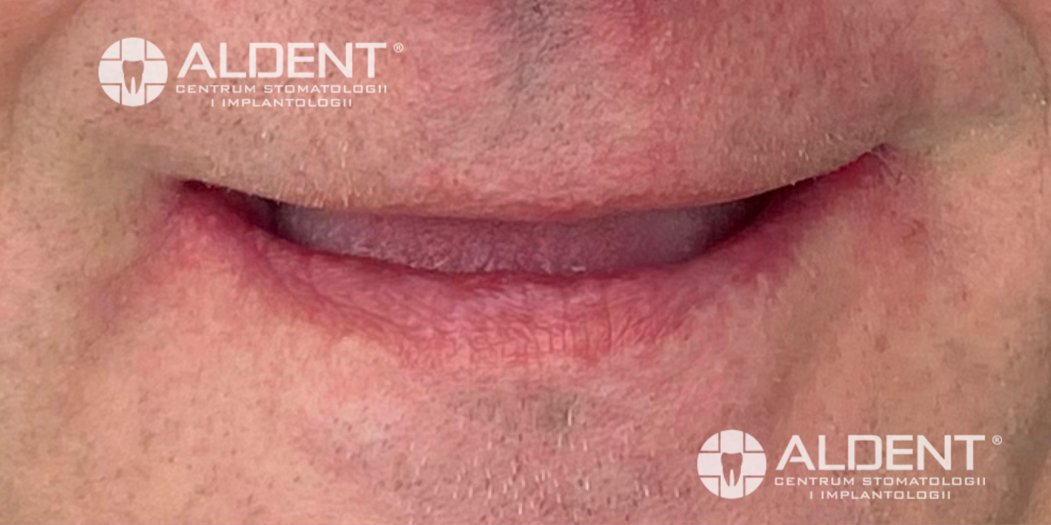 Bezzębie całkowite