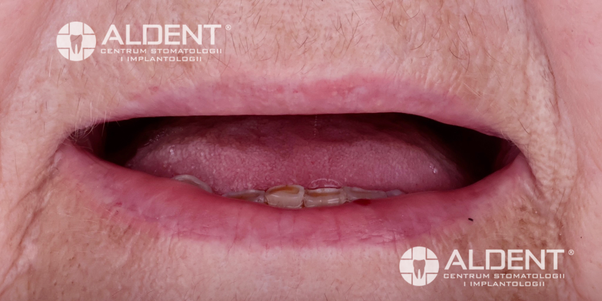 Bezzębie w łuku górnym