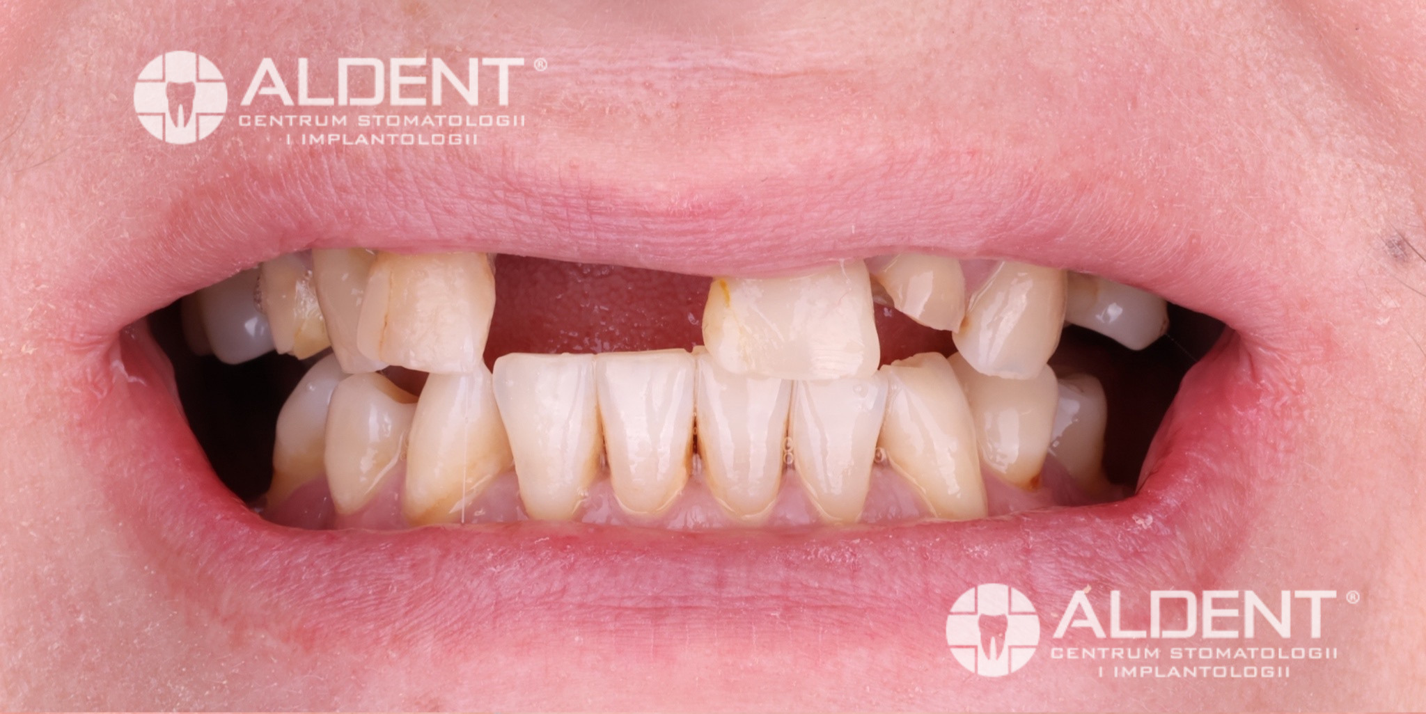 Brak jedynki i stłoczone zęby - Lublin - stan przed leczeniem