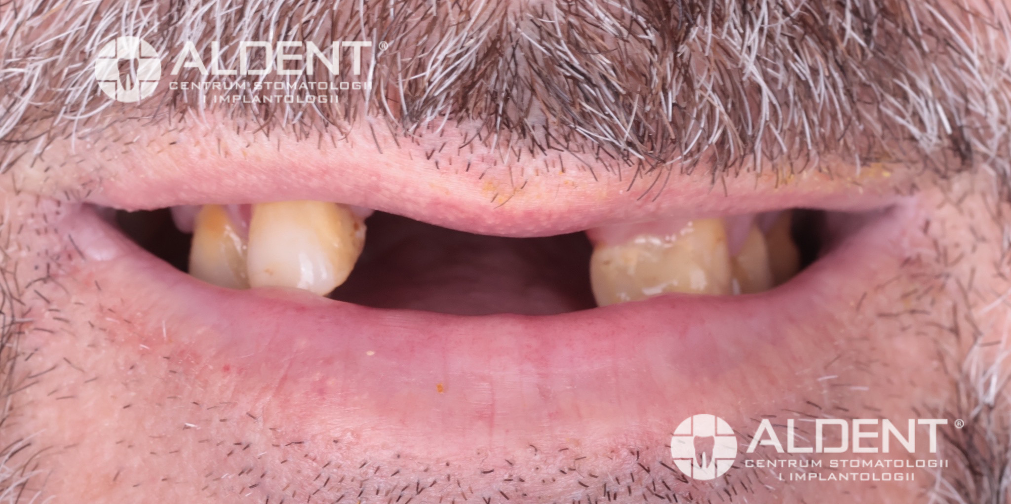 Brak siekaczy w łuku górnym Lublin - stan przed leczeniem