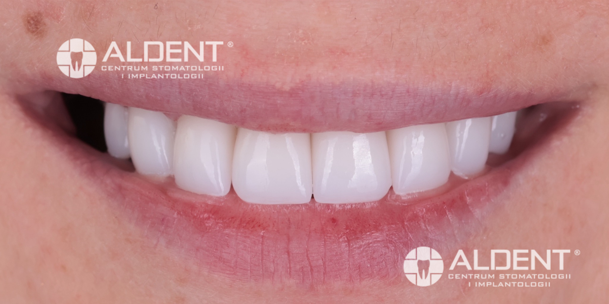 Estetyczna rekonstrukcja uśmiechu