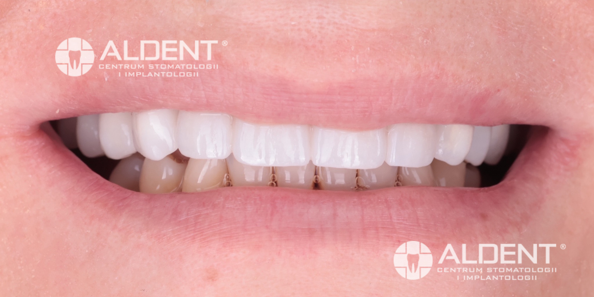 Korony cyrkonowe i most w odcinku przednim Lublin - efekt po leczeniu