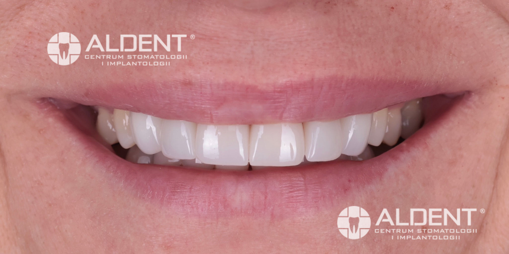 Korony i licówki pełnocyrkonowe