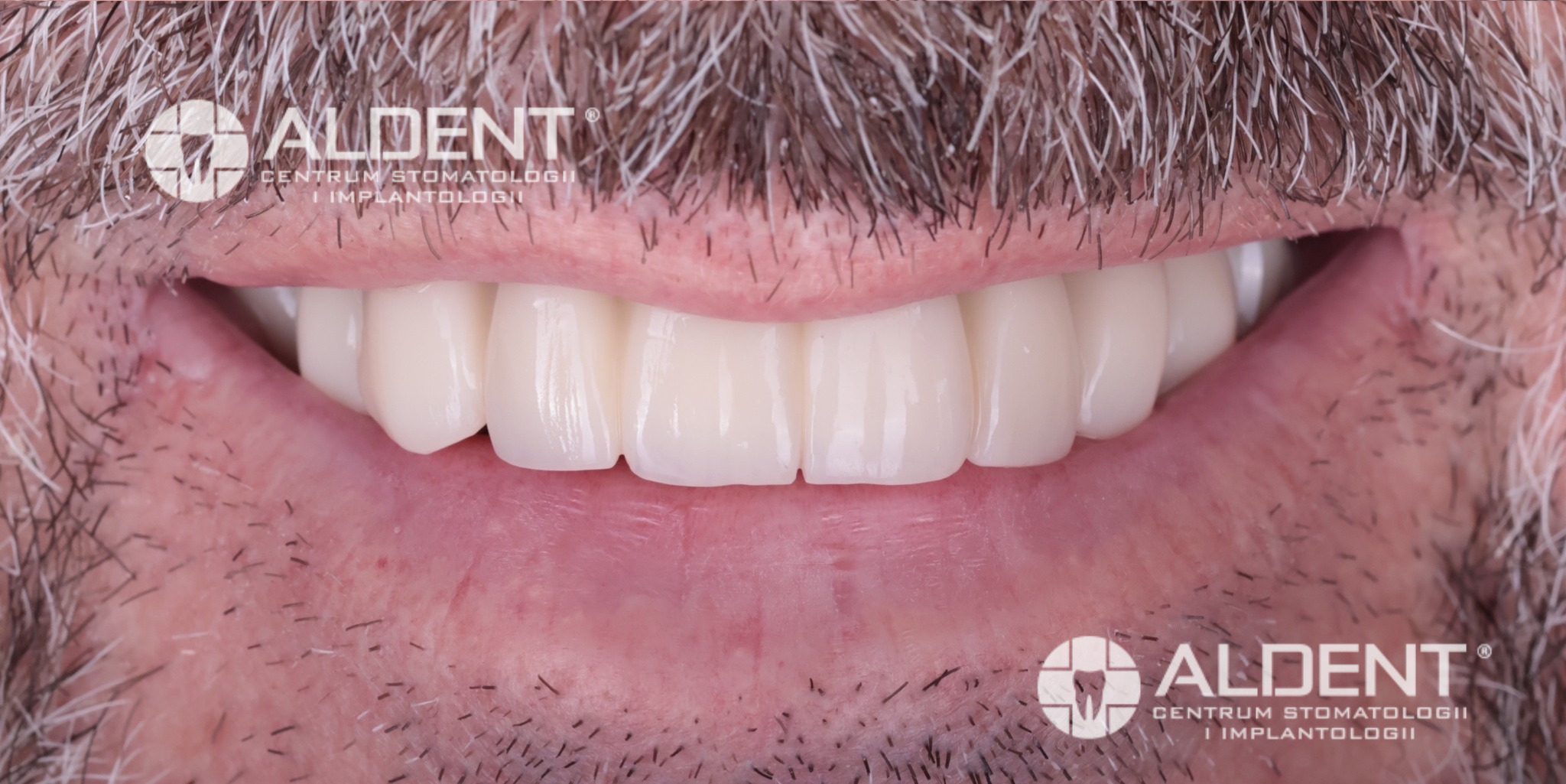 Licówki pełnoceramiczne Lublin - naturalny efekt uśmiechu po metamorfozie