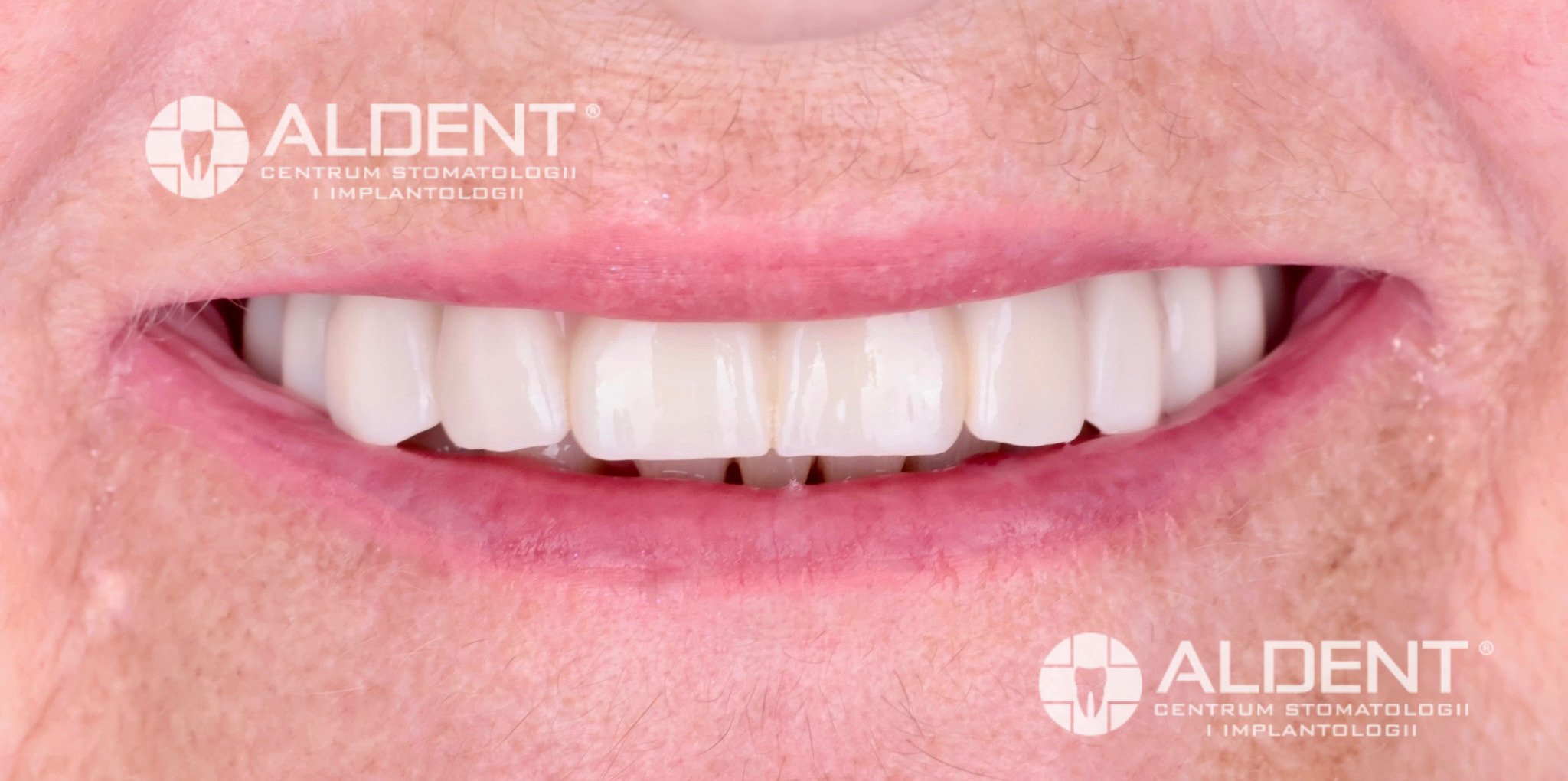 Metamorfoza na 6 implantach