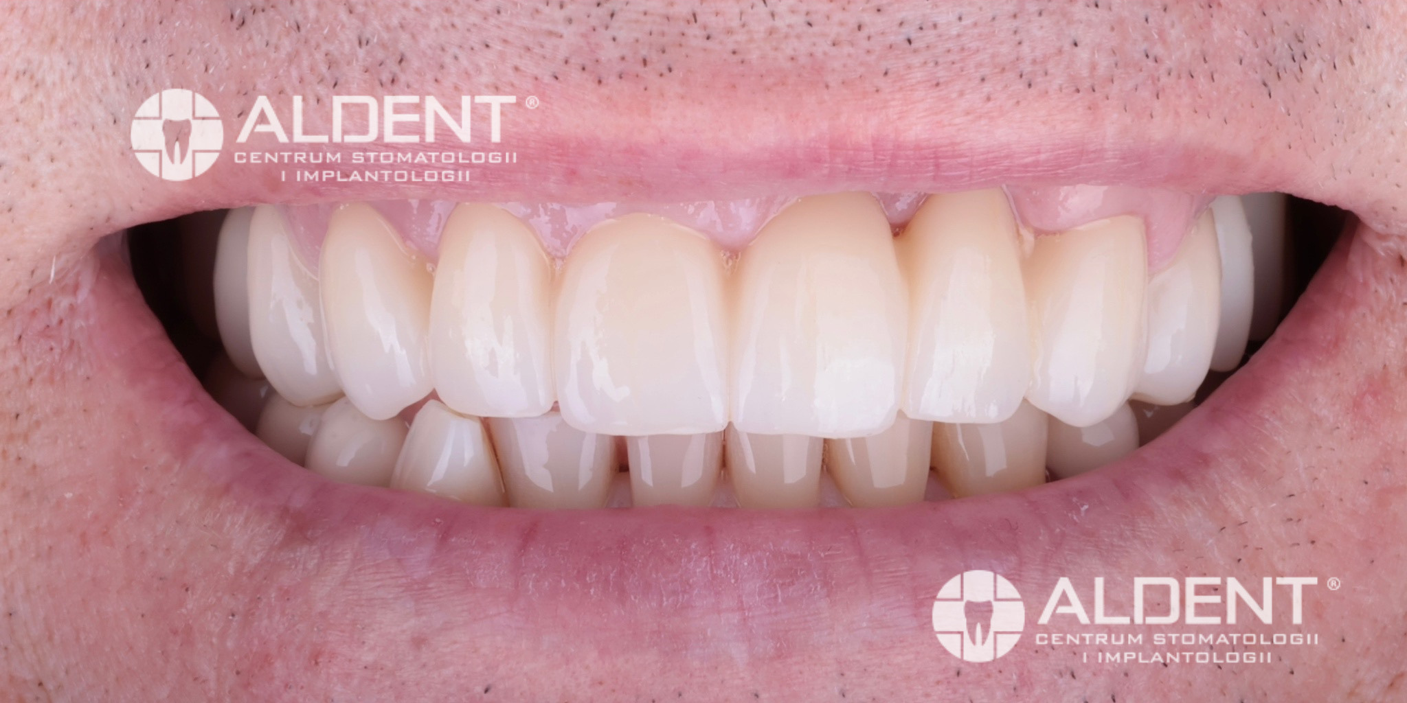 Metamorfoza po pełne rekonstrukcji