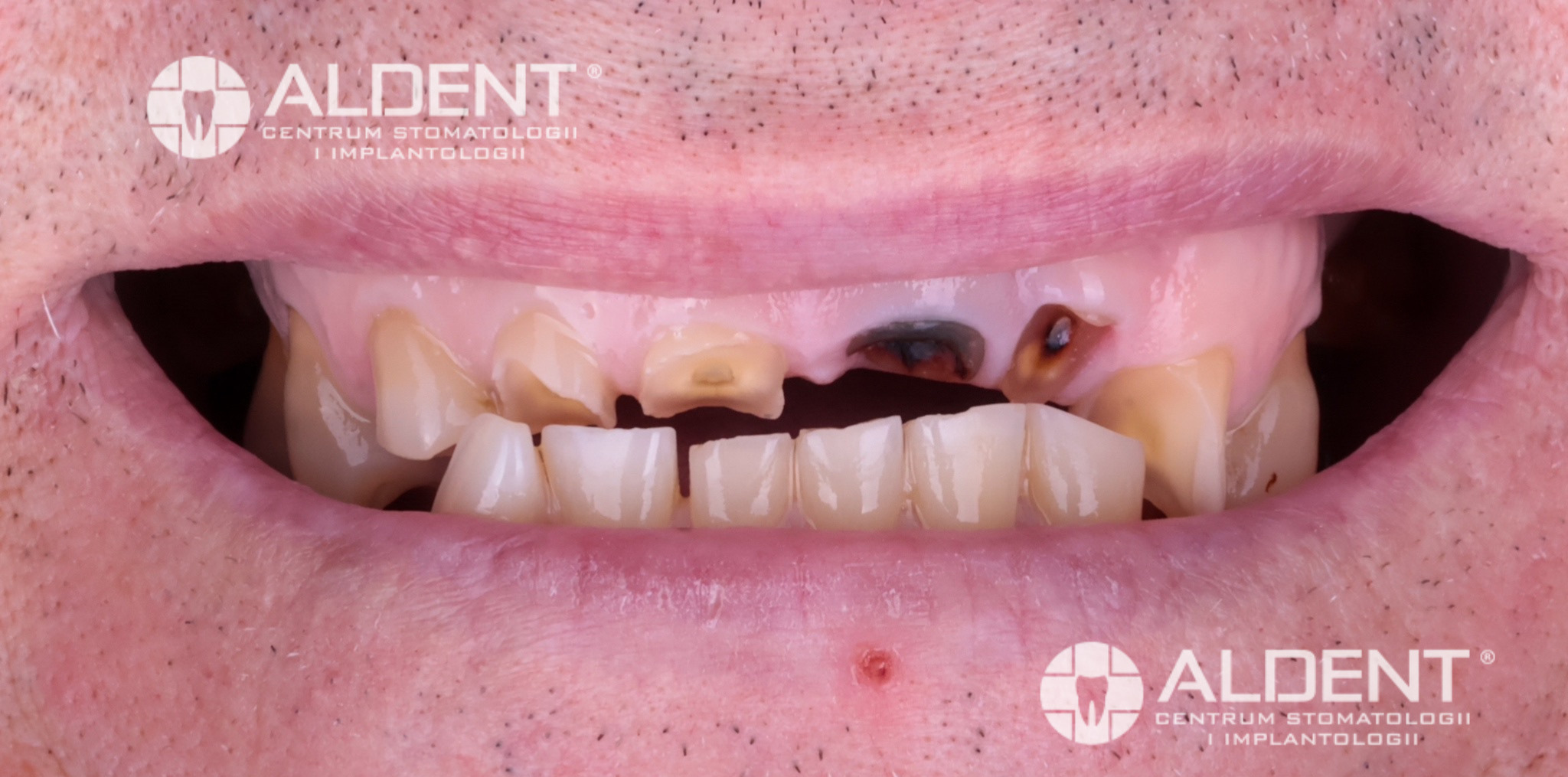 Metamorfoza przed rekonstrukcją