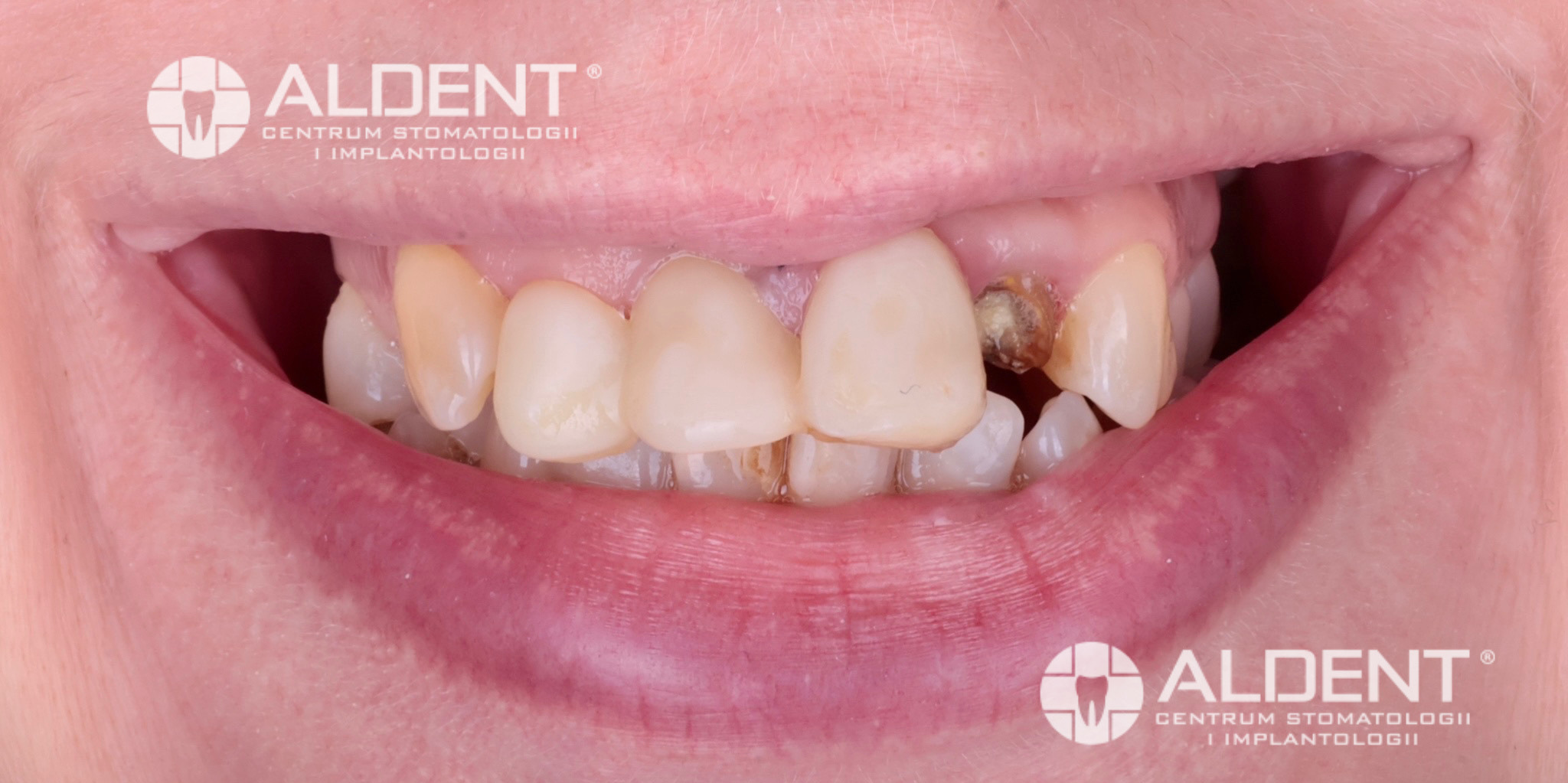 Nieestetyczne odbudowy kompozytowe zębów - stan przed leczeniem - Lublin