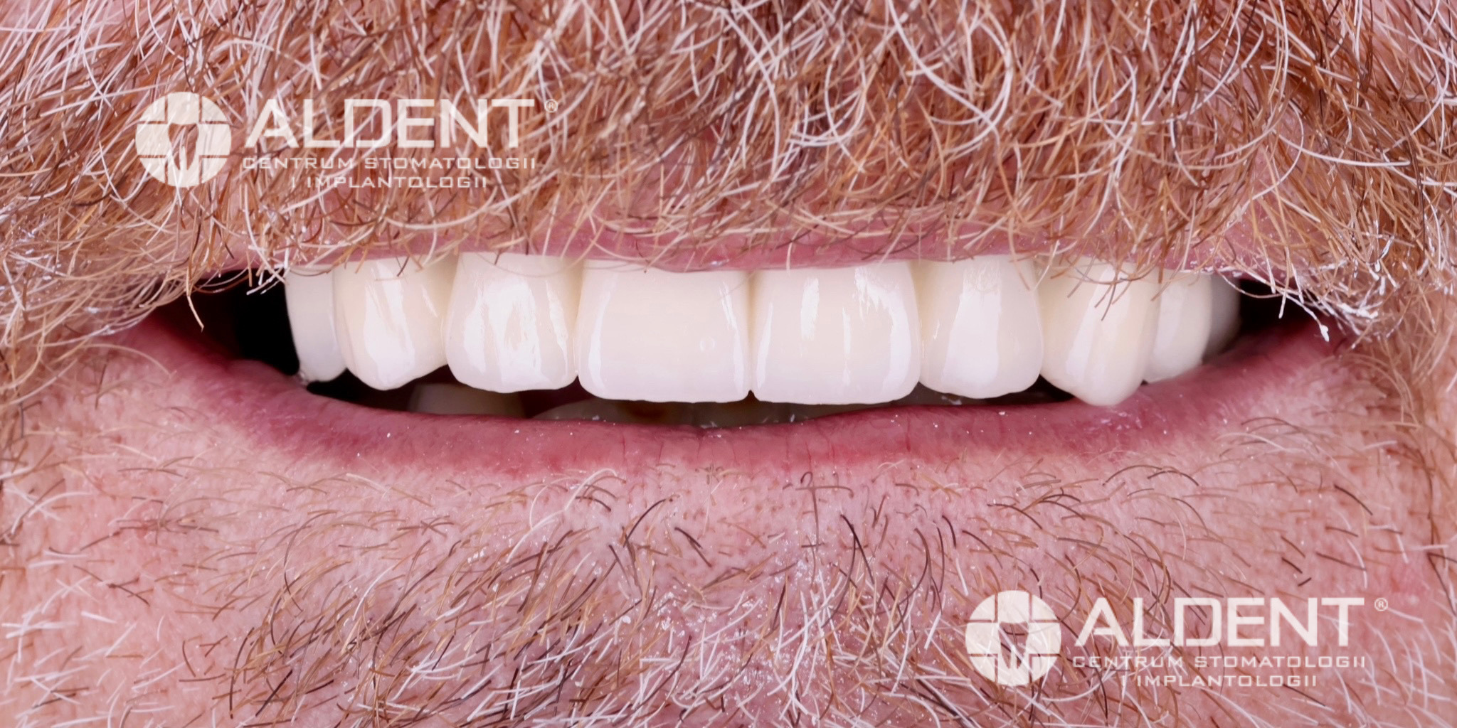 Nowe korony i mosty łuk górny - Lublin - efekt po leczeniu