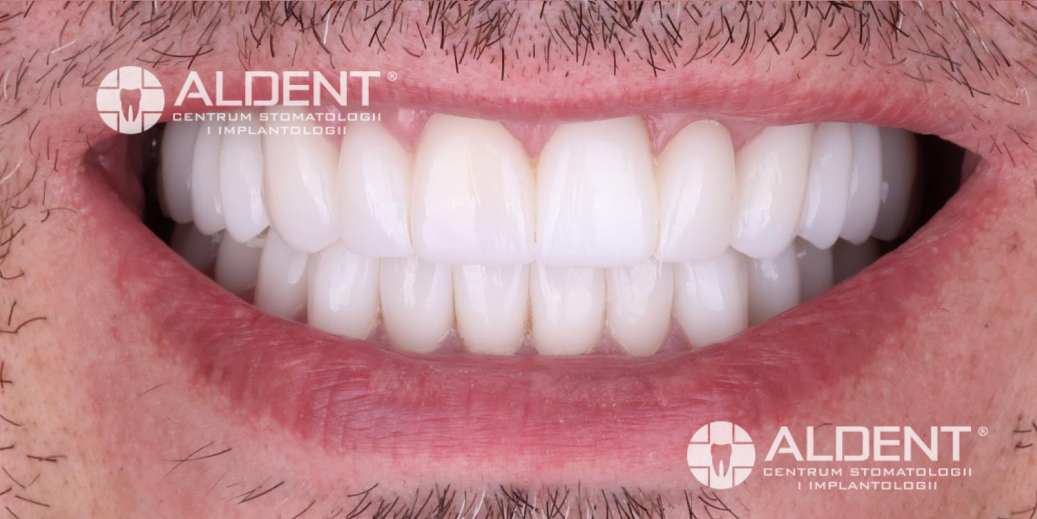 Odbudowa uśmiechu Lublin