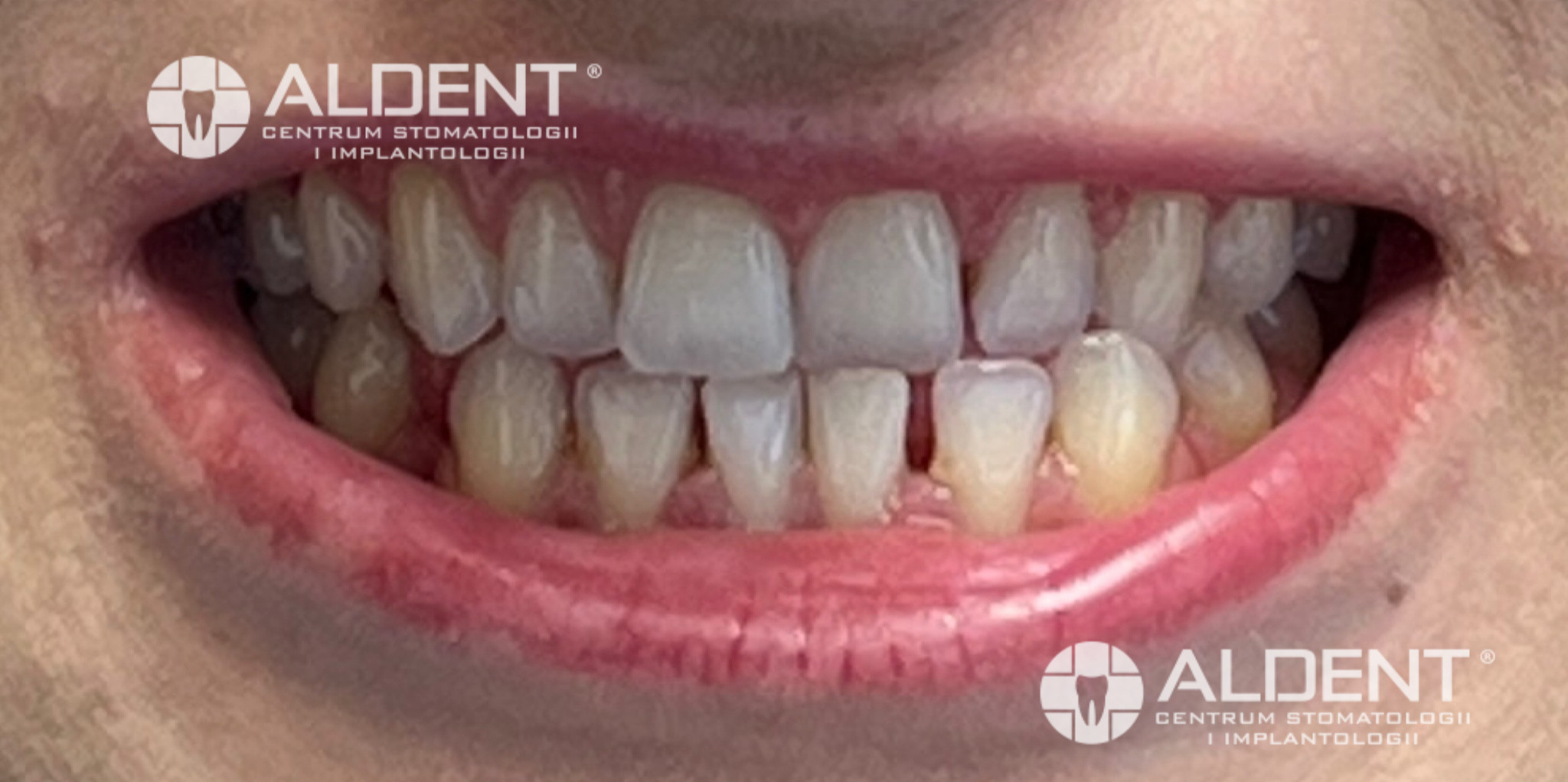 Przed metamorfozą Invisalign