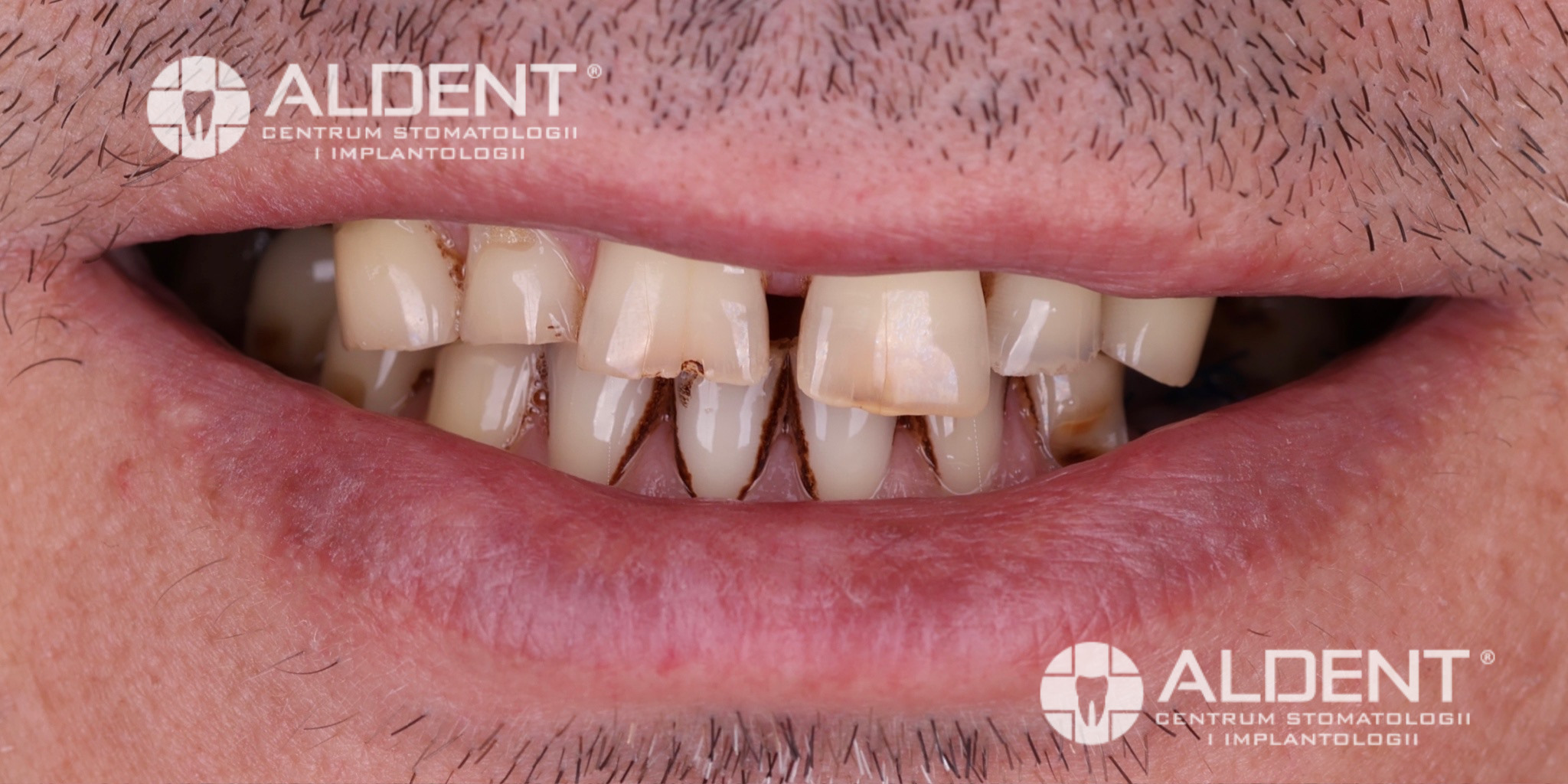 Stan przed odbudową uśmiechu