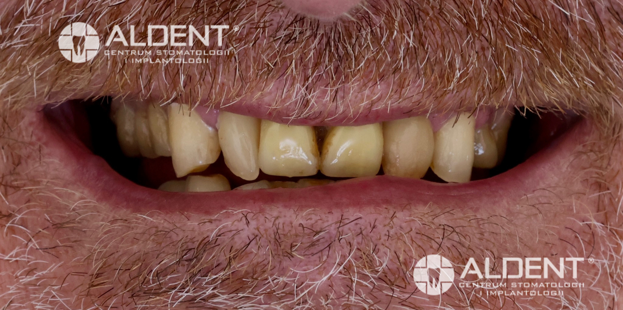 Stan przed wymianą protetyki