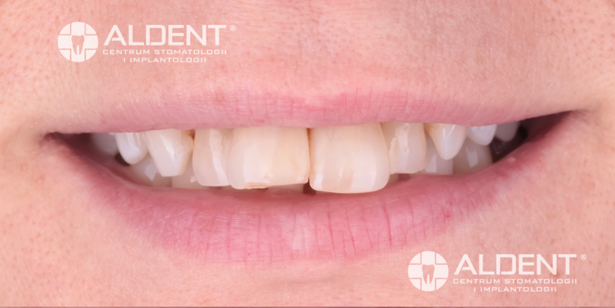 Uśmiech przed metamorfozą