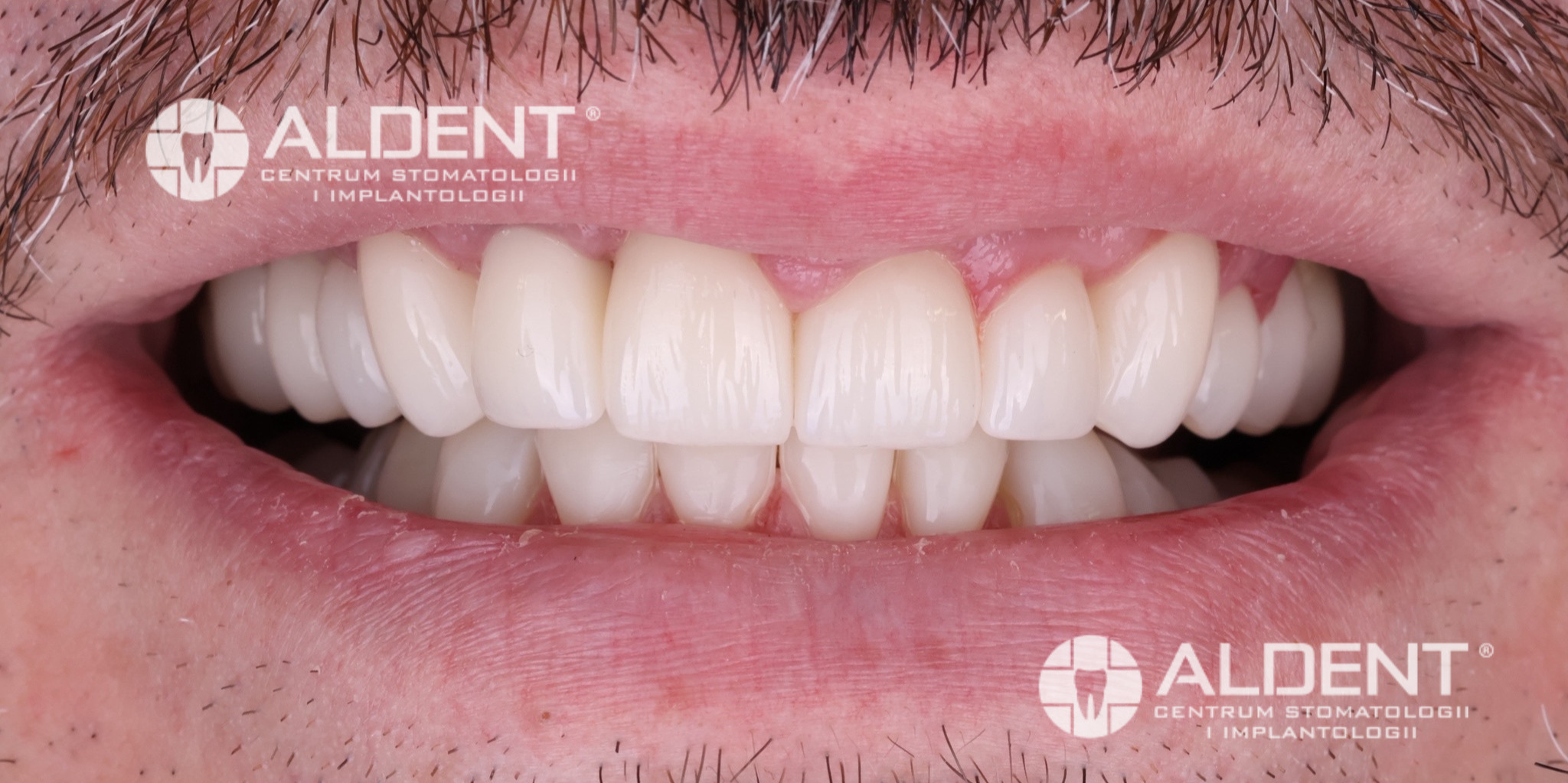 Zęby po pełnej metamorfozie