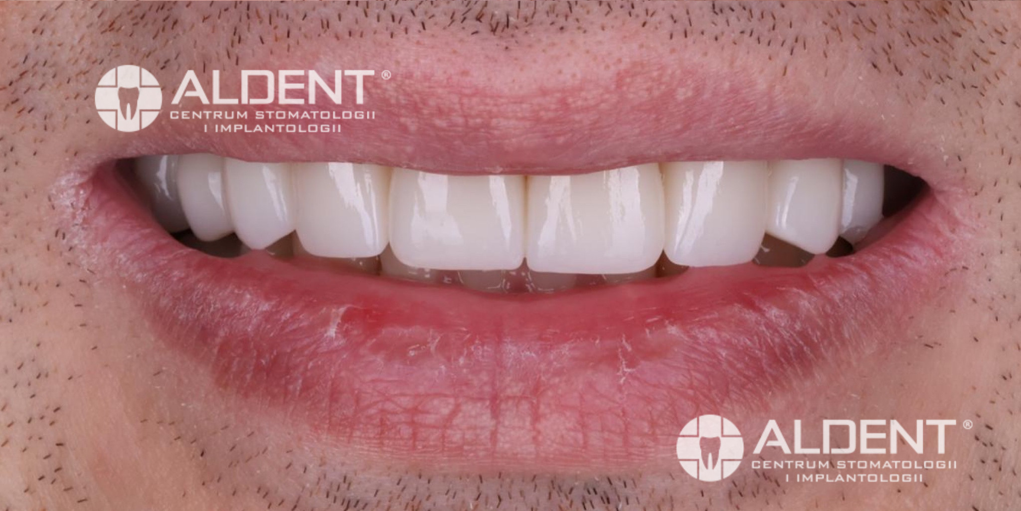 Zęby po zacementowaniu koron