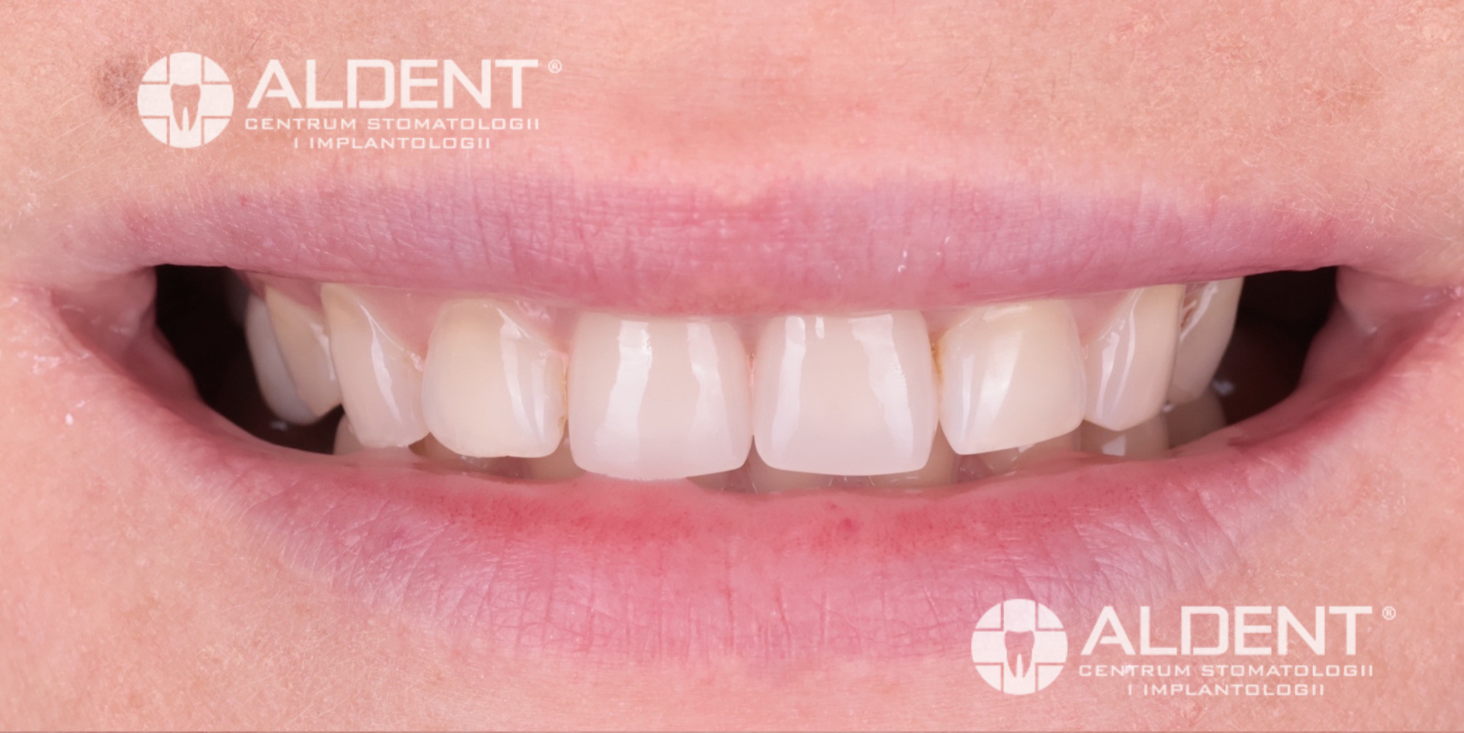 Zęby przed metamorfozą