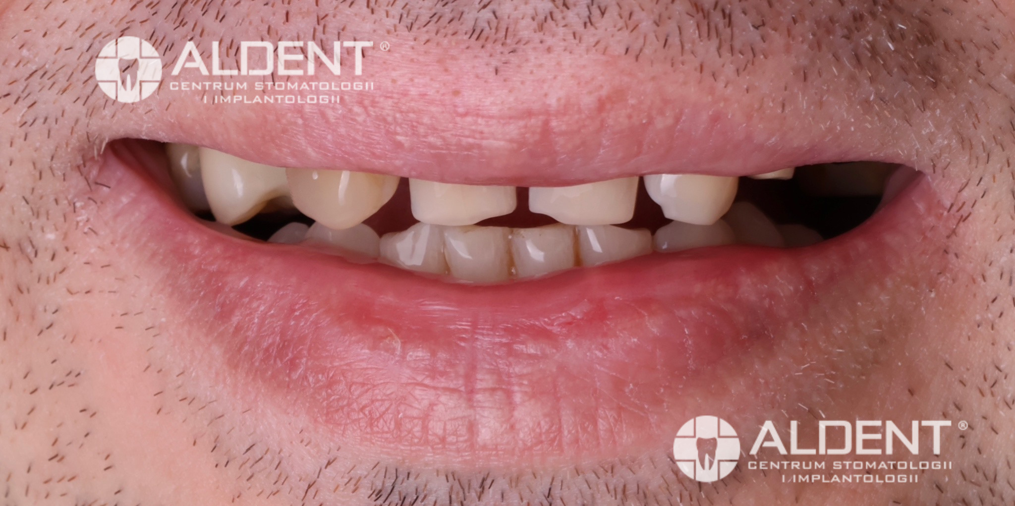 Zęby przed zacementowaniem koron